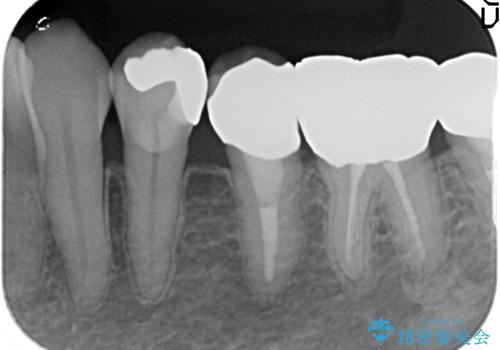 オールセラミッククラウン ズキズキ痛む歯の治療の治療前