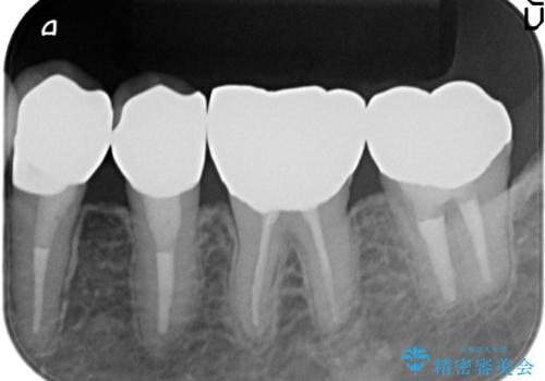 オールセラミッククラウン ズキズキ痛む歯の治療の治療後