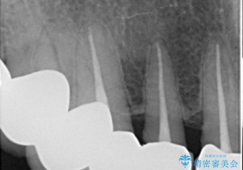 20年前に被せた前歯をやりかえたい 60代女性の治療前