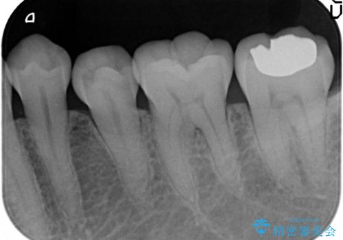 PGA(ゴールド)インレー 冷たいものがしみる歯の治療の治療後