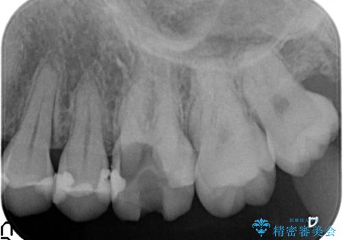 セラミック治療　痛くて咬めない奥歯の治療の治療前