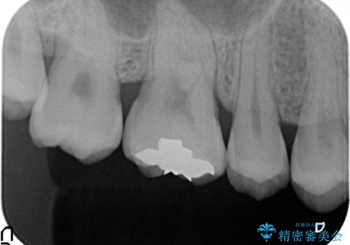 PGA(ゴールド)インレー 欠けた古い樹脂のやり替えの治療後