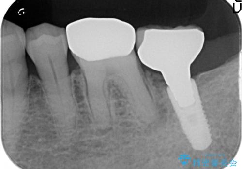 オールセラミッククラウン 咬むと痛む奥歯の根管治療の治療前