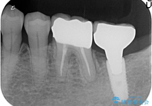 オールセラミッククラウン 咬むと痛む奥歯の根管治療の治療後