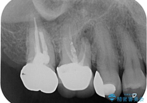 歯ぐきにニキビのようなものができた:原因から改善、被せ物までの治療前