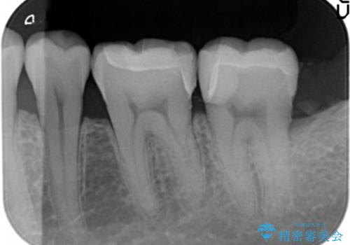 [セラミック治療]  目立つ銀歯を白く②の治療後