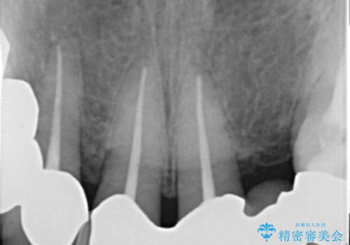 20年前に被せた前歯をやりかえたい 60代女性の治療前