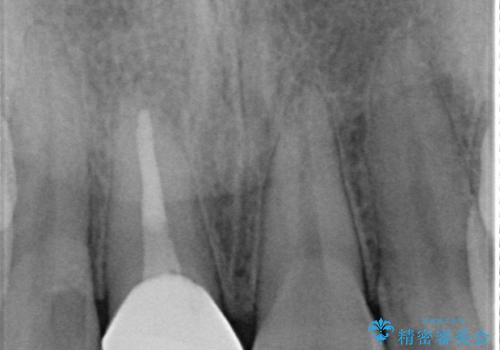 オールセラミッククラウン 痛みの引かない歯の治療の治療後
