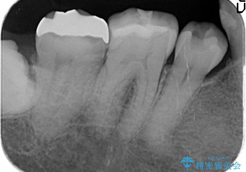 オールセラミッククラウン 奥歯の見た目の改善の治療前