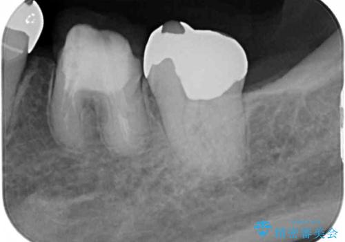 話しにくく腫れやすい前歯のブリッジ 使用感の良いオールセラミックブリッジにの治療前