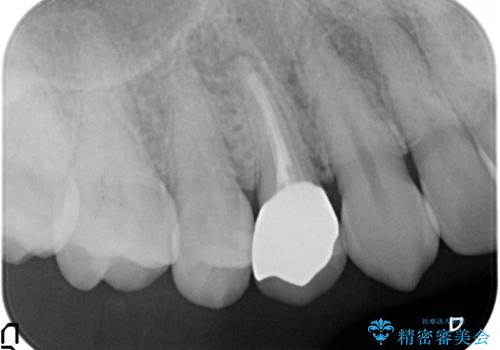 オールセラミッククラウン 歯茎の腫れが引かない歯の治療の治療後
