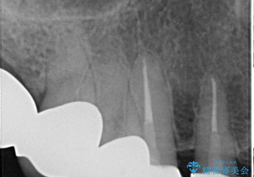 20年前に被せた前歯をやりかえたい 60代女性の治療後