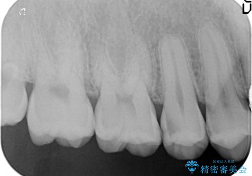 虫歯をなおしたい、セラミックインレー修復の治療前