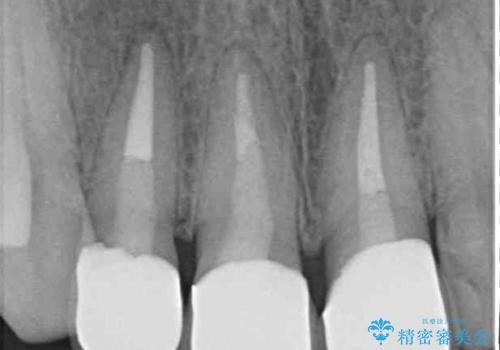 前歯の審美歯科治療 オールセラミッククラウンと部分矯正の治療後
