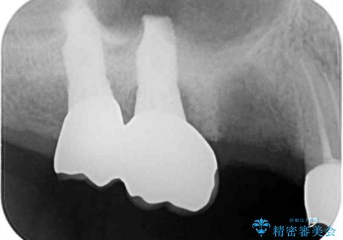 折れてしまった歯 インプラントによる補綴治療の治療前