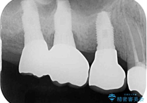 折れてしまった歯 インプラントによる補綴治療の治療後