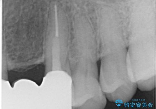 20年前に被せた前歯をやりかえたい 60代女性の治療後