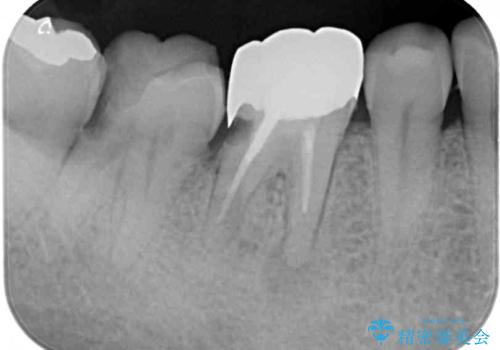 骨の中にまで及んだ深い虫歯 歯周外科処置を用いた補綴治療の治療前