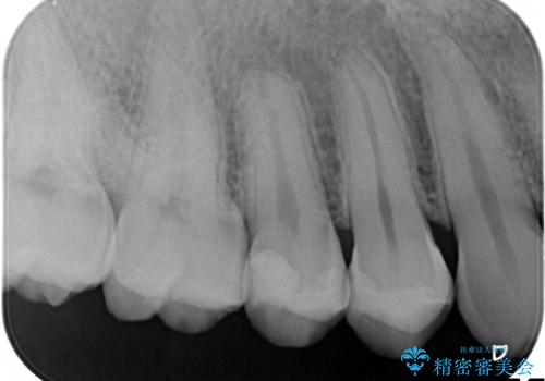 虫歯をなおしたい、セラミックインレー修復の治療後