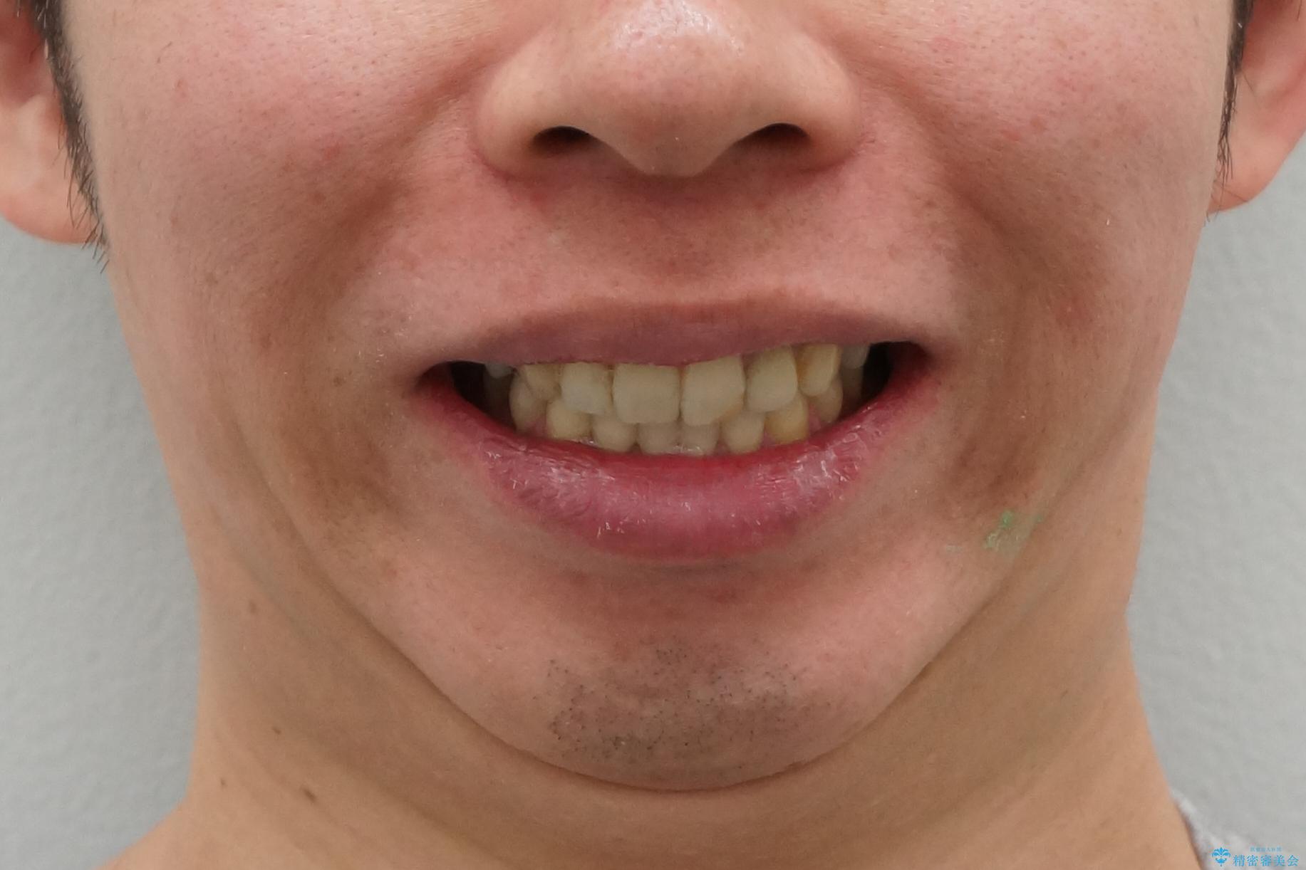 出っ歯　すれ違い咬合の改善　の治療後（顔貌）