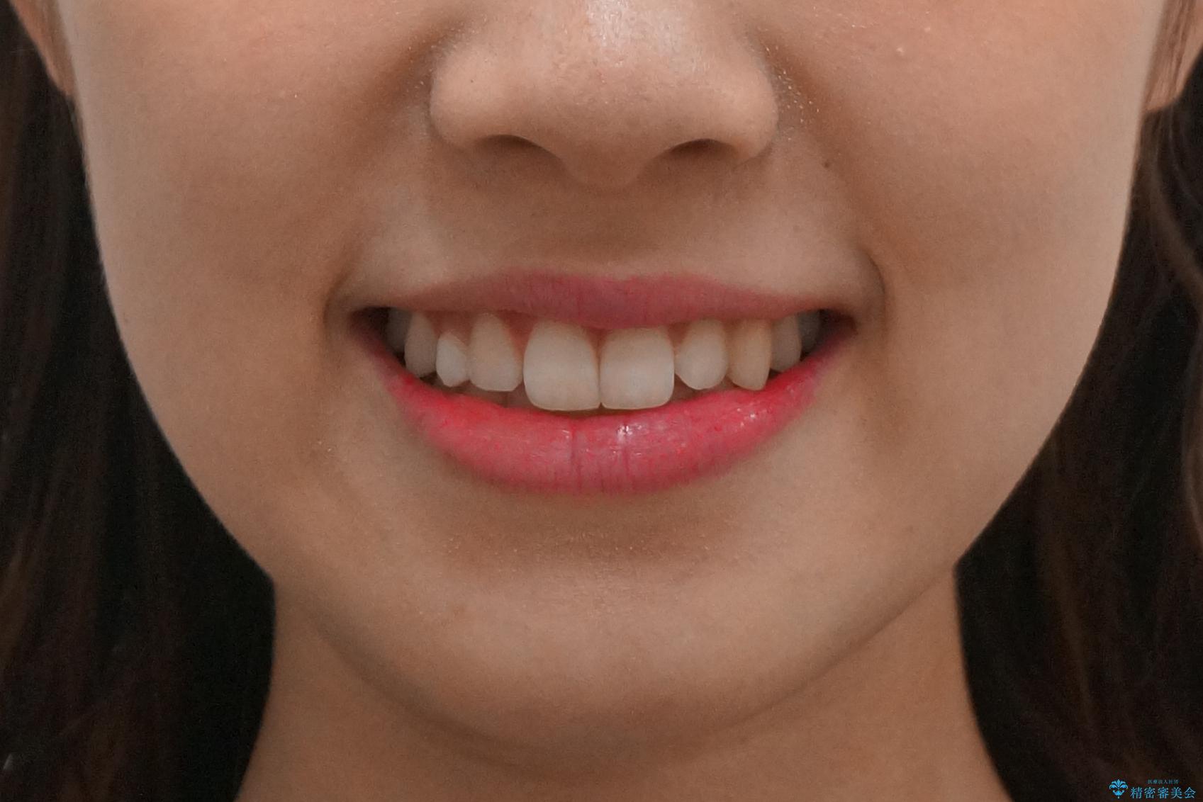 前歯のがたつき　乳歯を抜かずに矯正の治療後（顔貌）