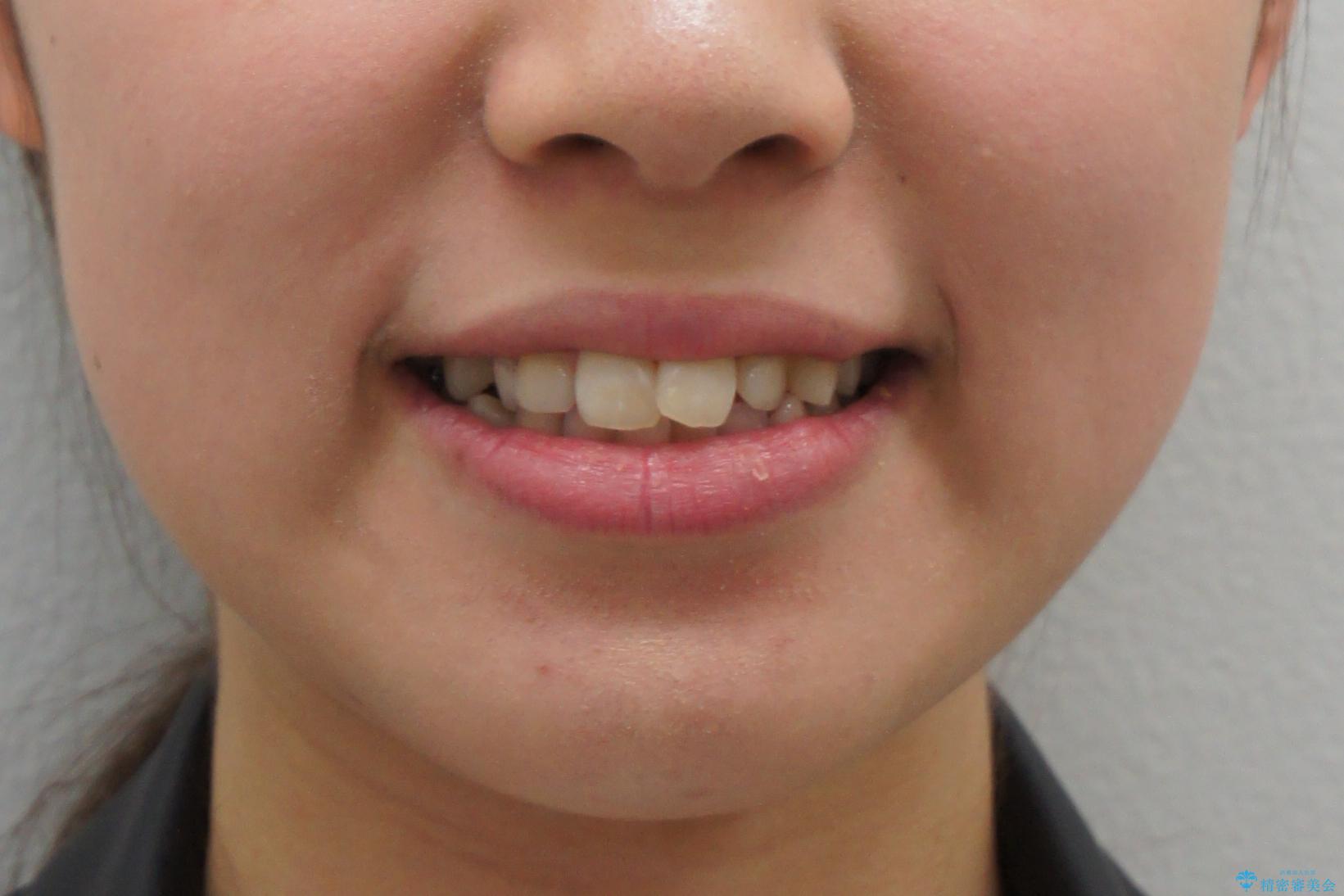 前歯のがたつき　乳歯を抜かずに矯正の治療前（顔貌）