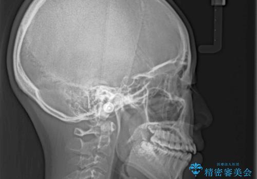 気になる前歯をインビザラインで綺麗にの治療前