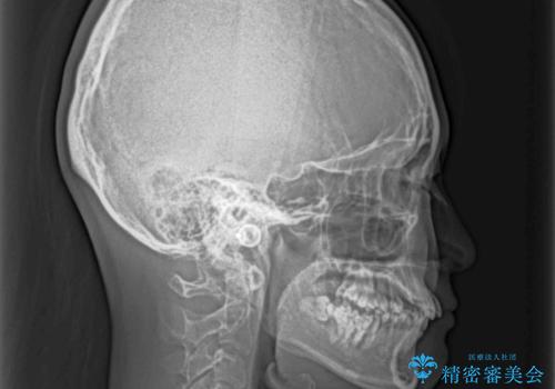 奥歯の倒れた歯を改善 インビザラインでの矯正治療の治療前