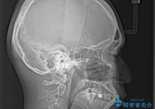 口が少し閉じにくい インビザラインによる非抜歯矯正の治療前