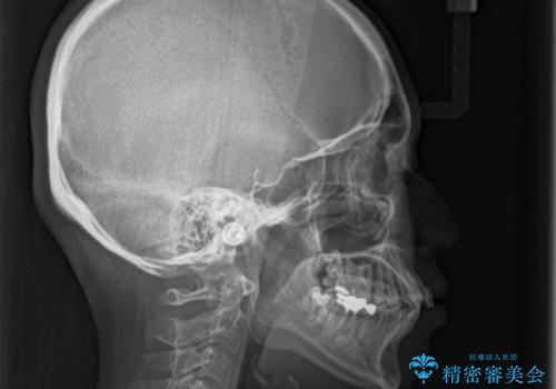 インプラント治療とインビザライン矯正治療 総合歯科治療の治療前