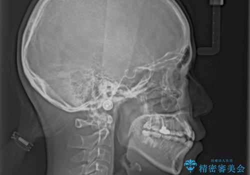八重歯の抜歯矯正 費用を抑えた矯正装置の治療前