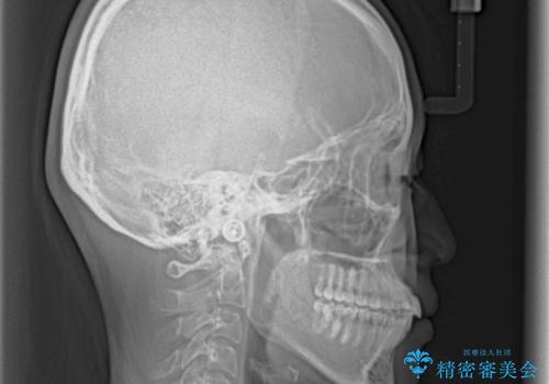 短期間での歯列矯正 ワイヤー矯正であっという間にの治療後