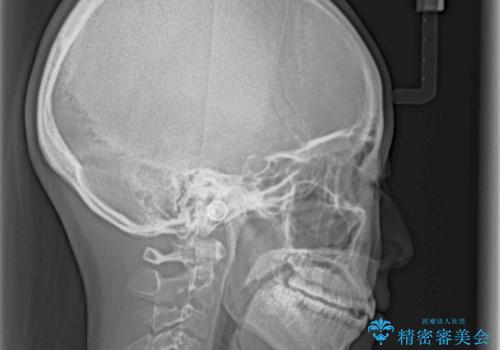 気になる前歯をインビザラインで綺麗にの治療後