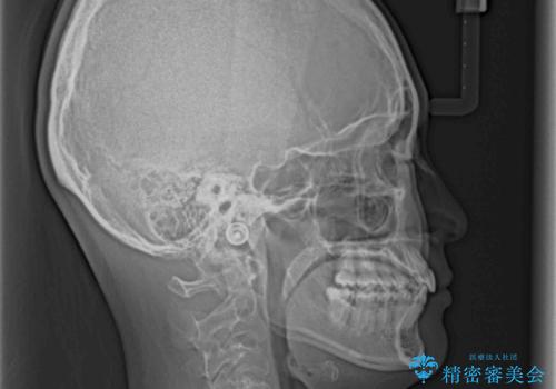 奥歯の倒れた歯を改善 インビザラインでの矯正治療の治療後
