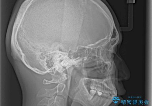 口が少し閉じにくい インビザラインによる非抜歯矯正の治療後