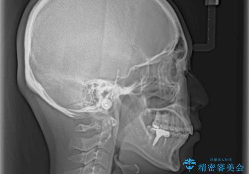 インプラント治療とインビザライン矯正治療 総合歯科治療の治療後