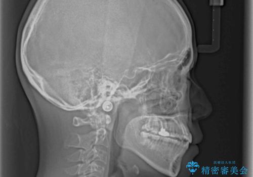 八重歯の抜歯矯正 費用を抑えた矯正装置の治療後