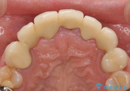 オールセラミッククラウン 前歯の被せ物を綺麗にの治療前