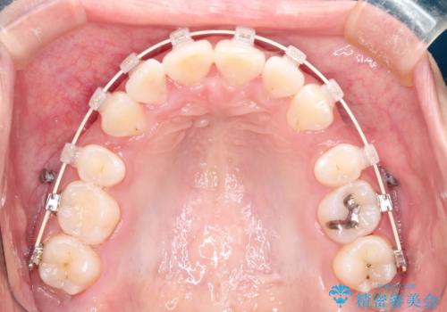 前歯のがたつき・出っ歯 ワイヤーによる抜歯矯正の治療中