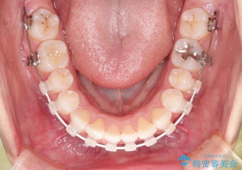 前歯のがたつき・出っ歯 ワイヤーによる抜歯矯正の治療中