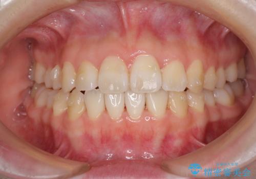気になる前歯をインビザラインで綺麗にの治療中
