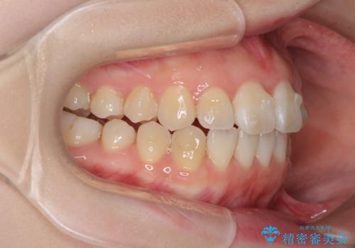 気になる前歯をインビザラインで綺麗にの治療中