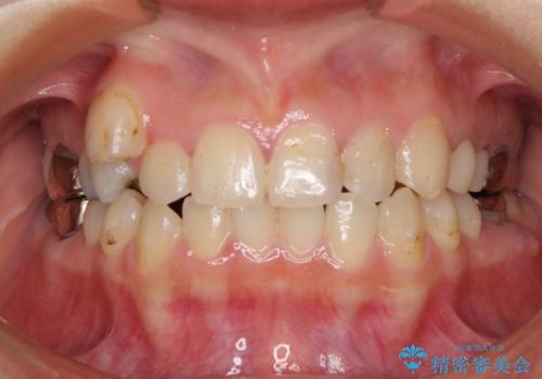 結婚式前に目立つ銀歯をセラミックにの症例 治療前
