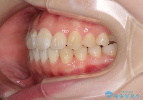 気になる前歯をインビザラインで綺麗にの治療中