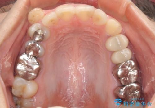 結婚式前に目立つ銀歯をセラミックにの治療前