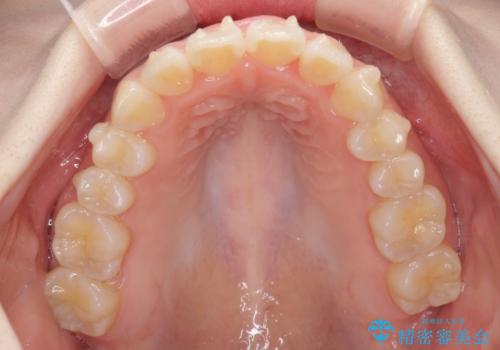 気になる前歯をインビザラインで綺麗にの治療中
