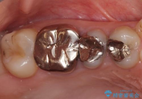 結婚式前に目立つ銀歯をセラミックにの治療前