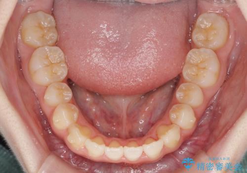気になる前歯をインビザラインで綺麗にの治療中