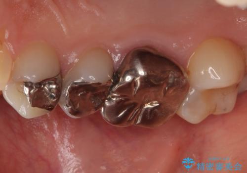 結婚式前に目立つ銀歯をセラミックにの治療前