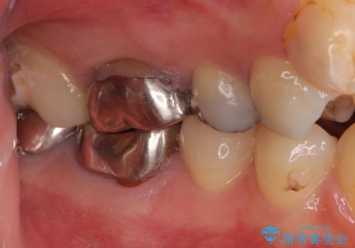 結婚式前に目立つ銀歯をセラミックにの治療前